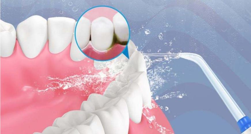 洗牙和龈下刮治的区别在哪里？