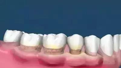 需要牙周刮治.jpg 需要牙周刮治.jpg