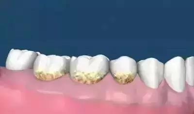 不需要牙周刮治.jpg 不需要牙周刮治.jpg