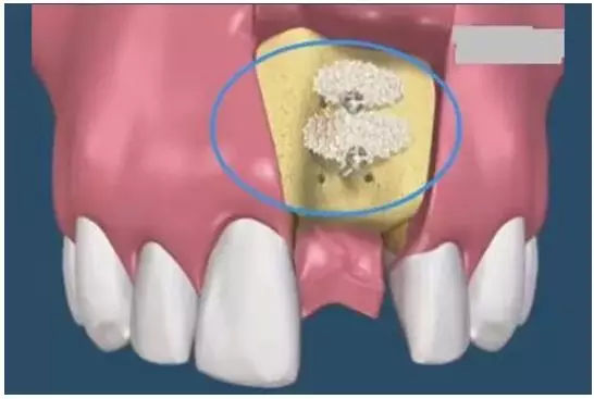 骨粉.jpg 骨粉.jpg