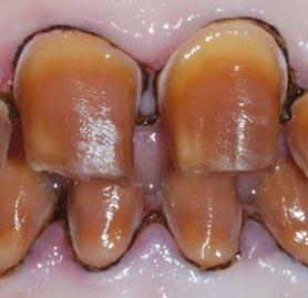 四环素牙2.jpg 四环素牙2.jpg