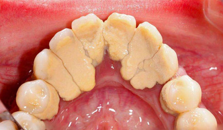 牙结石.jpg 牙结石.jpg