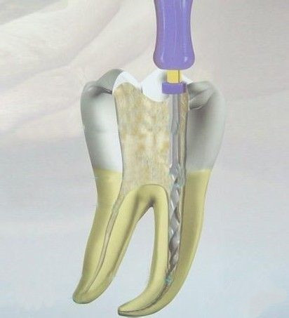 根管治疗后，牙齿还很疼是什么回事？