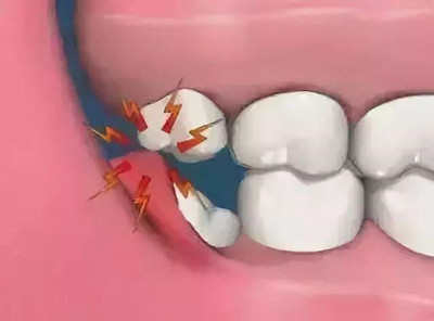 智齿一定要拔吗？警惕这几种情况