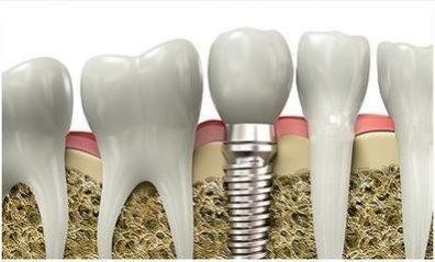 做种植牙前，医生为什么会建议植骨粉？