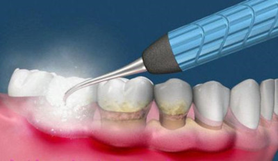 洗牙会伤害牙体？洗牙的这些误区你要了解