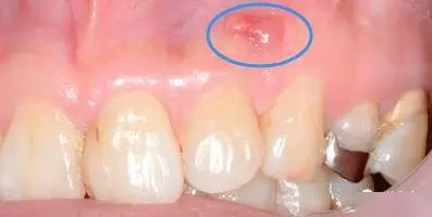 牙龈长脓胞，可以用针戳破吗？